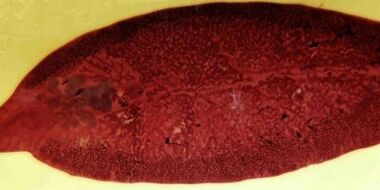 parasita trematódeo como remover do corpo