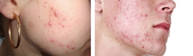erupção cutânea como sintoma da presença de vermes subcutâneos